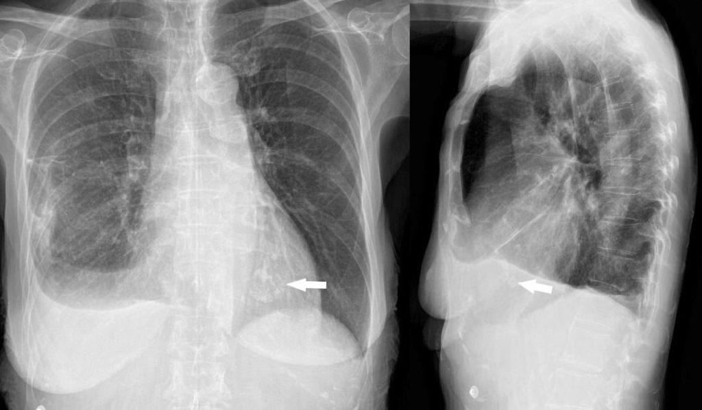 Left Ventricle Calcification Heart