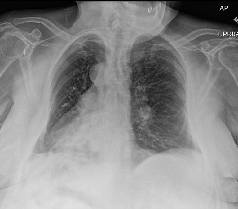 Kartagener’s Syndrome, Primary Ciliary Dyskinesia | Heart