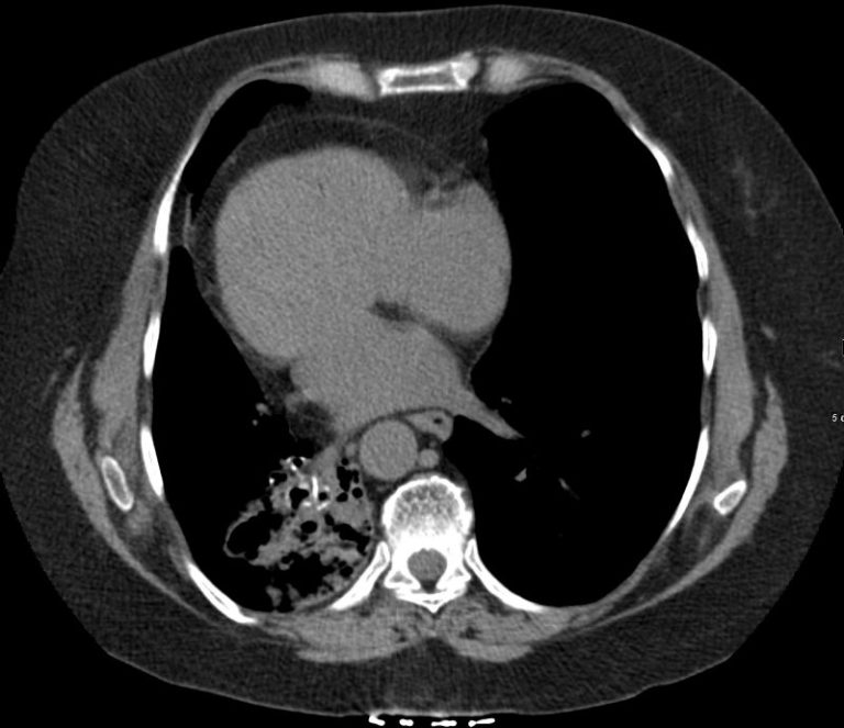 Kartagener’s Syndrome, Primary Ciliary Dyskinesia | Heart