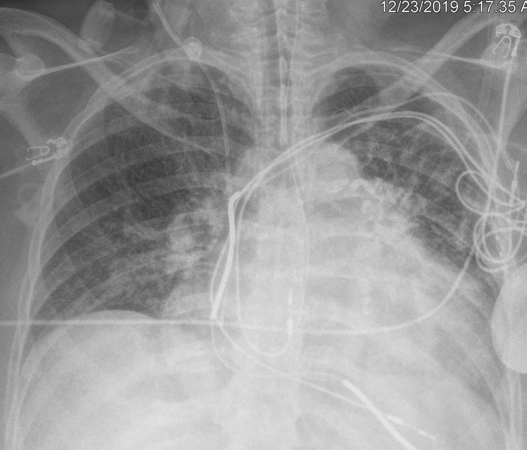 Right Atrium Size | Heart