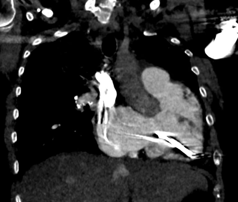 Right Atrium Size | Heart