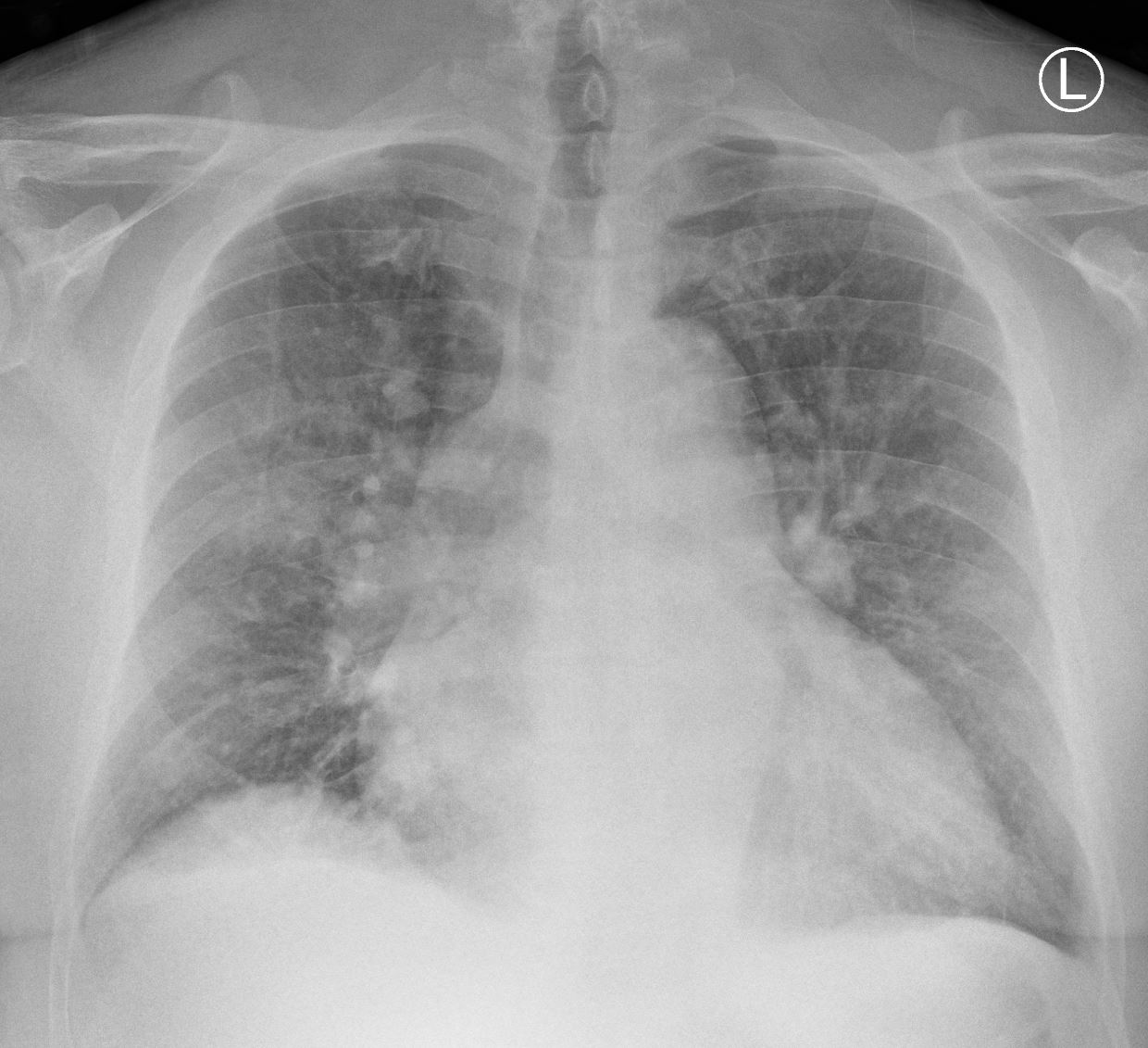 Chest X-ray and Heart Failure, CXR and CHF | Heart