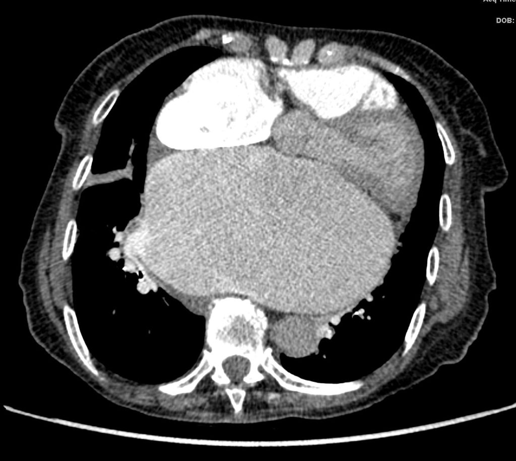 Left Atrium Size 