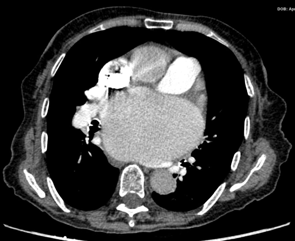 Left Atrium Size | Heart