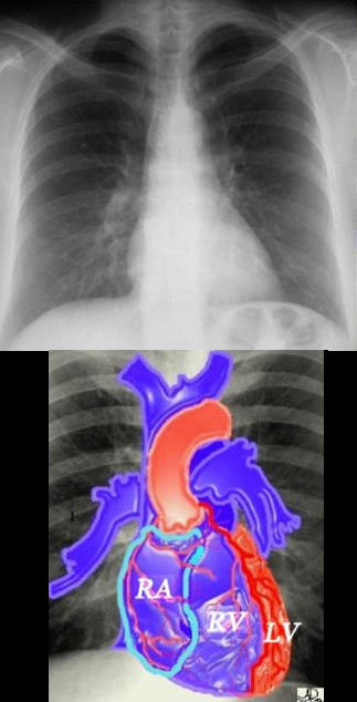 Clinical picture (A) Asymmetric chest with hypoplastic and flattened