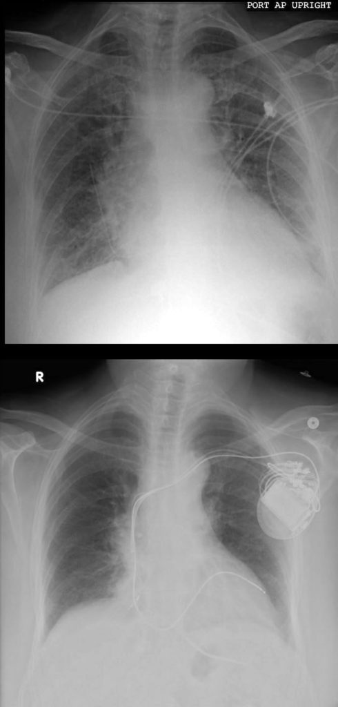 050h Chf, Cxr, And Interstitial Edema 