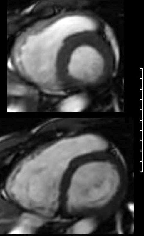 MRI Short Axis Heart