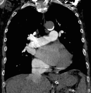 CXR Straight heart Border Chest X-ray | Heart