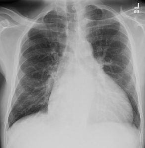 CXR Straight heart Border Chest X-ray | Heart