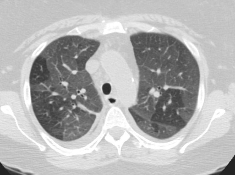 ct-chf-and-ground-glass-heart