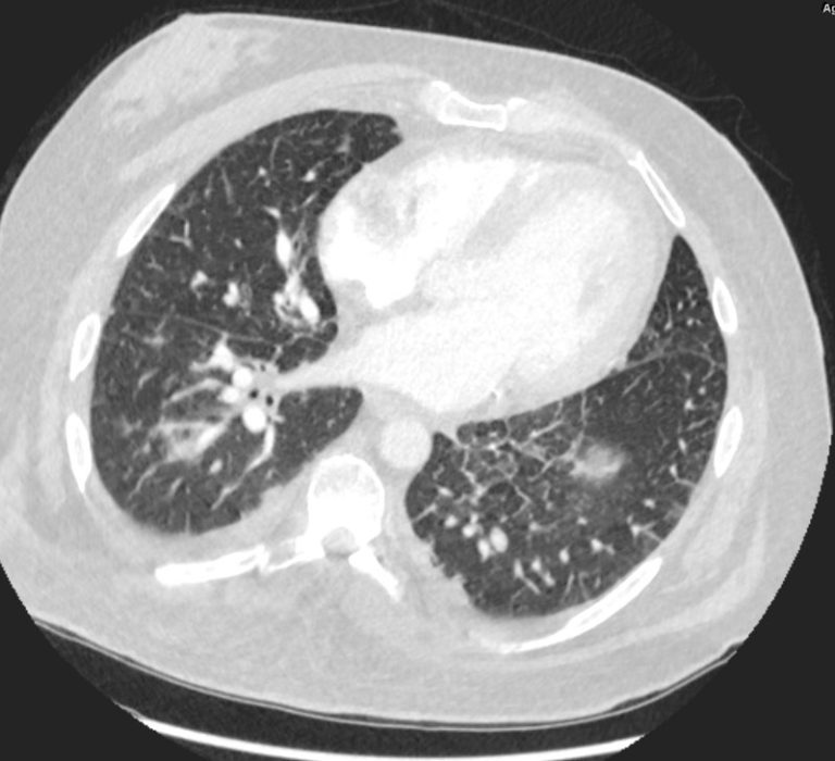 024H CHF Kerley b CXR CT | Heart