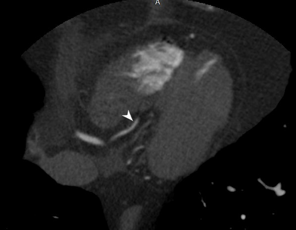 Coronary Artery Anatomy – CT – Posterior Descending Artery-PDA | Heart