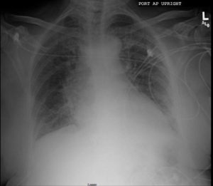 050H CHF, CXR, and Interstitial Edema | Heart