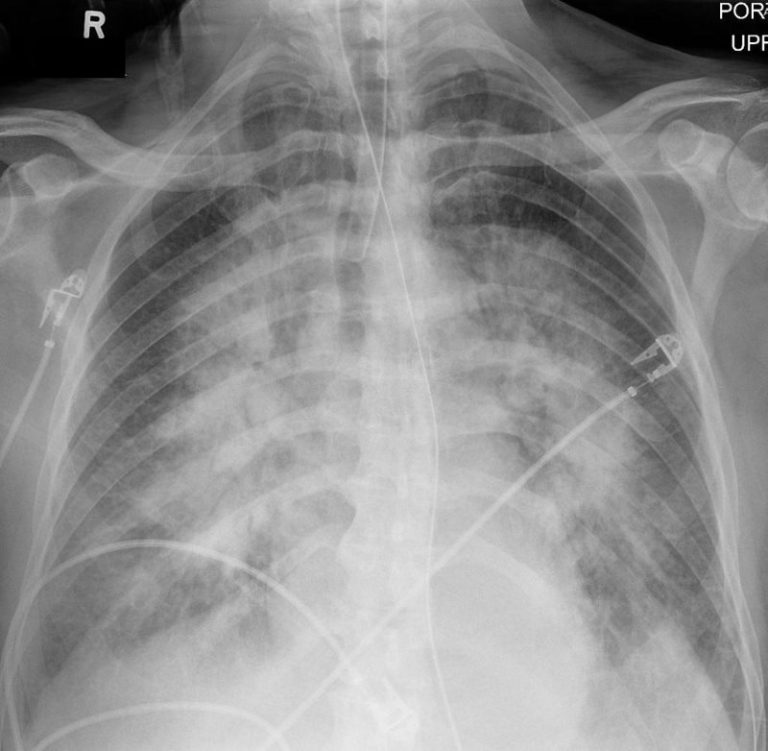 047H Acute MI Left Main Occlusion Batwing CXR | Heart