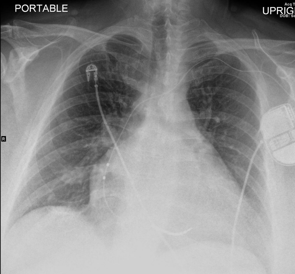 CXR Interstitial Edema | Heart