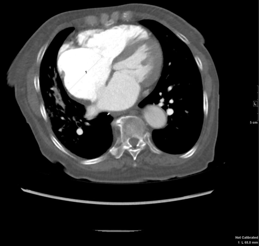 054H Scoliosis Difficult CXR Pulm HT and Septum Primum Bulge | Heart