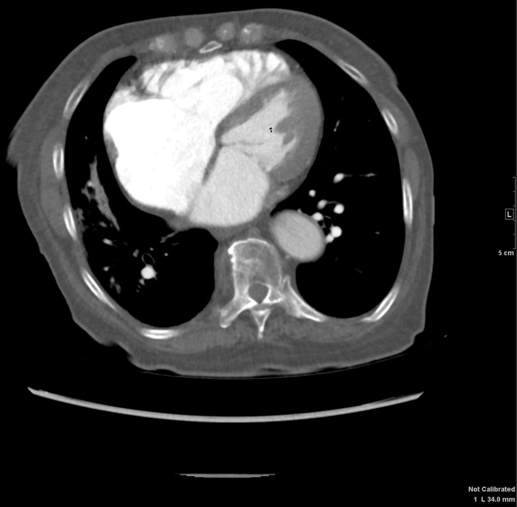 054H Scoliosis Difficult CXR Pulm HT and Septum Primum Bulge | Heart