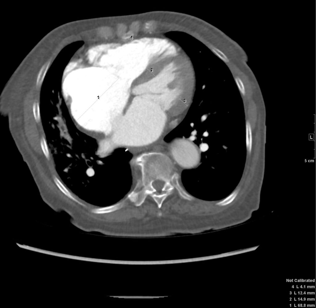 054H Scoliosis Difficult CXR Pulm HT and Septum Primum Bulge | Heart