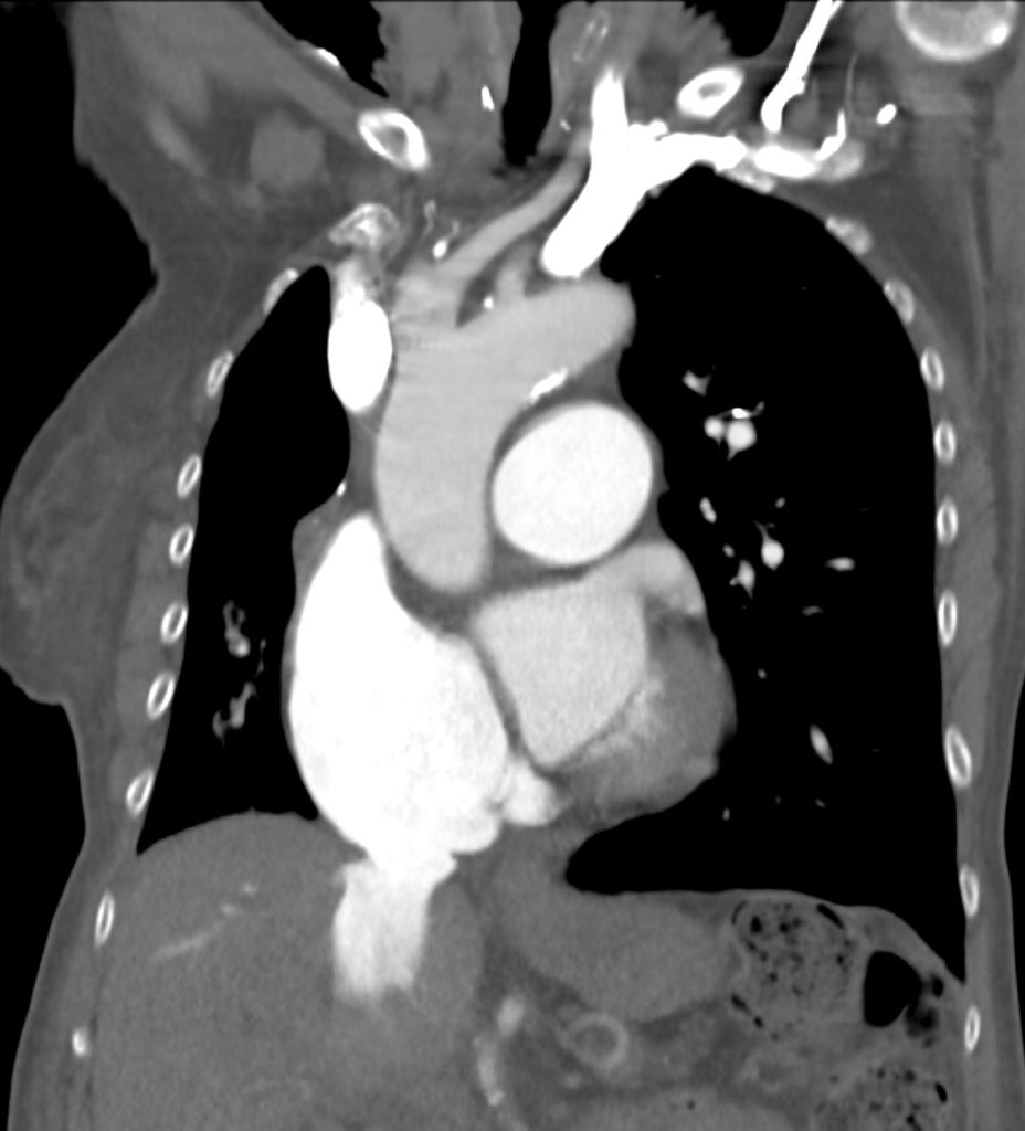 054H Scoliosis Difficult CXR Pulm HT and Septum Primum Bulge | Heart