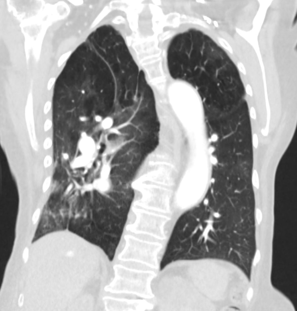 054H Scoliosis Difficult CXR Pulm HT and Septum Primum Bulge | Heart