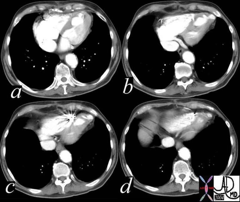 Left Ventricle Diverticulum (LV) | Heart