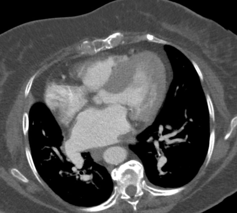 Left Ventricle (LV) Size and CT | Heart