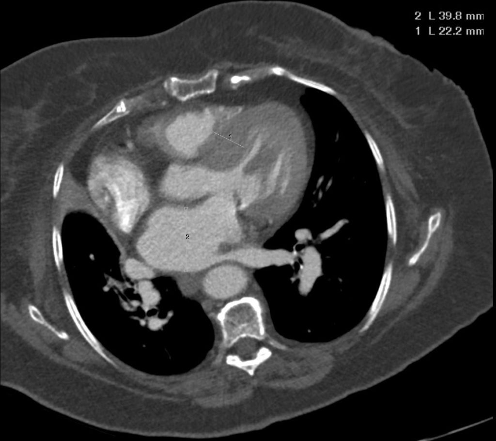 Left Ventricle (LV) Size and CT | Heart