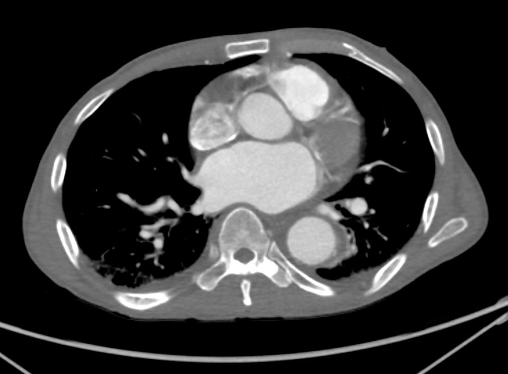 061H 71M RA thrombus saccular anurysms | Heart