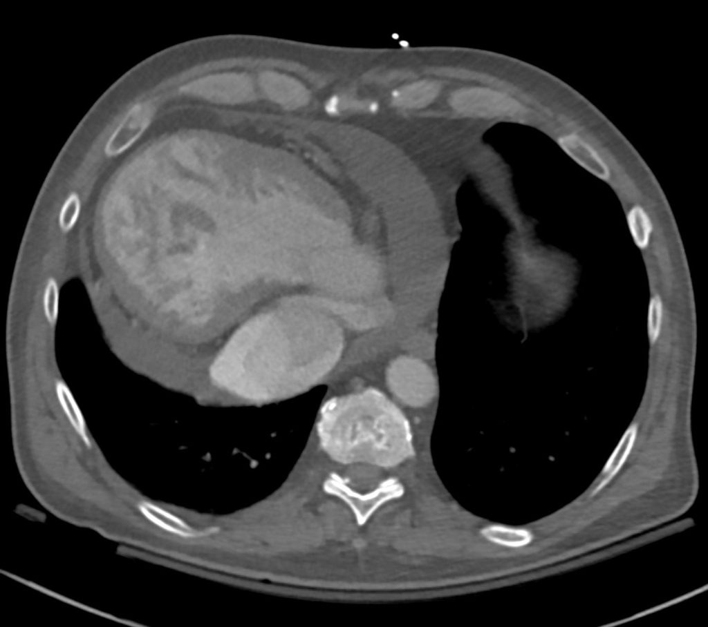 064h 50m Single Ventricle Ltga 