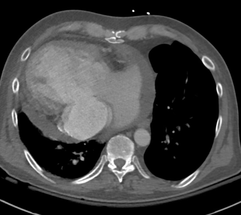 064H 50M Single Ventricle LTGA | Heart