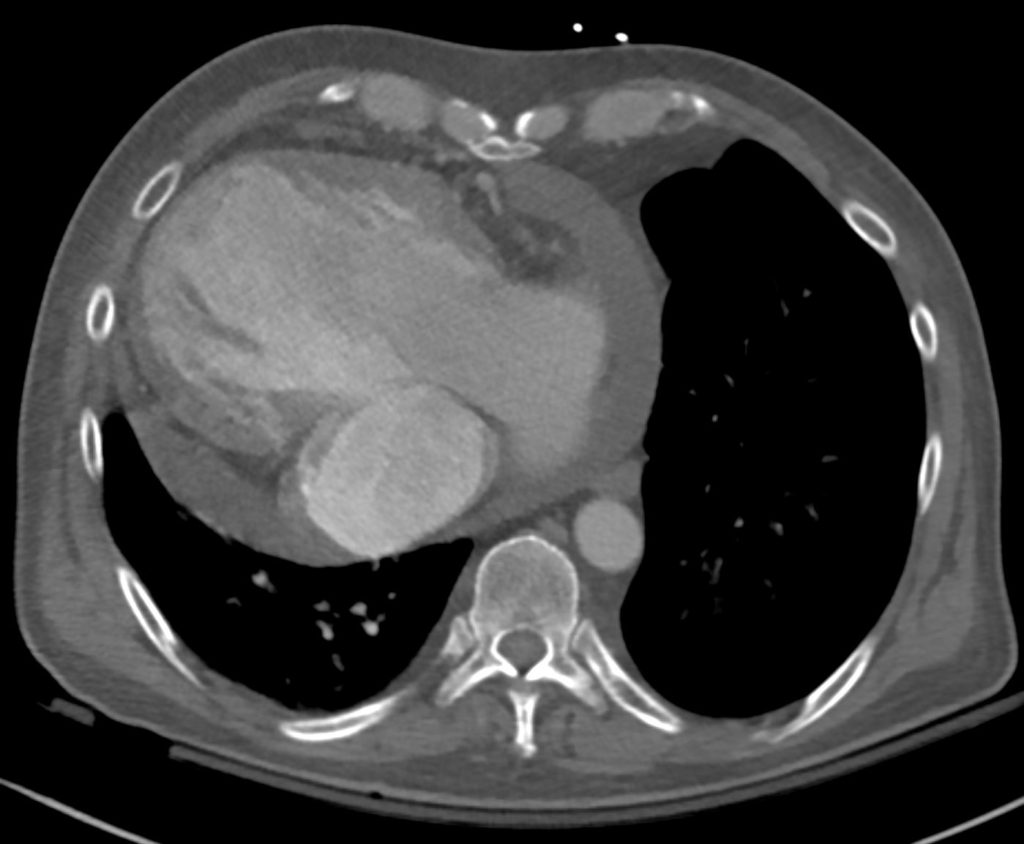 064H 50M Single Ventricle LTGA | Heart