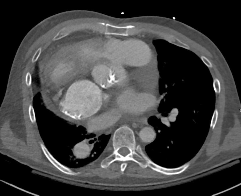 064H 50M Single Ventricle LTGA | Heart