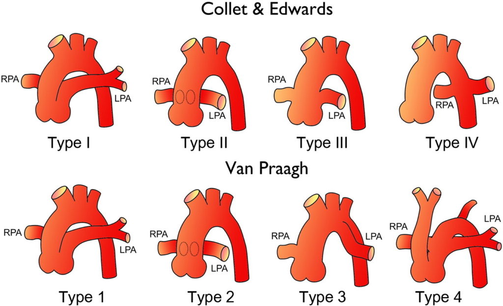 Truncus Arteriosus | Heart