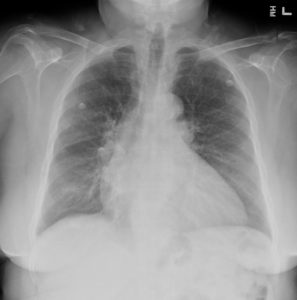 078H Apical Hypertrophic Cardiomyopathy | Heart