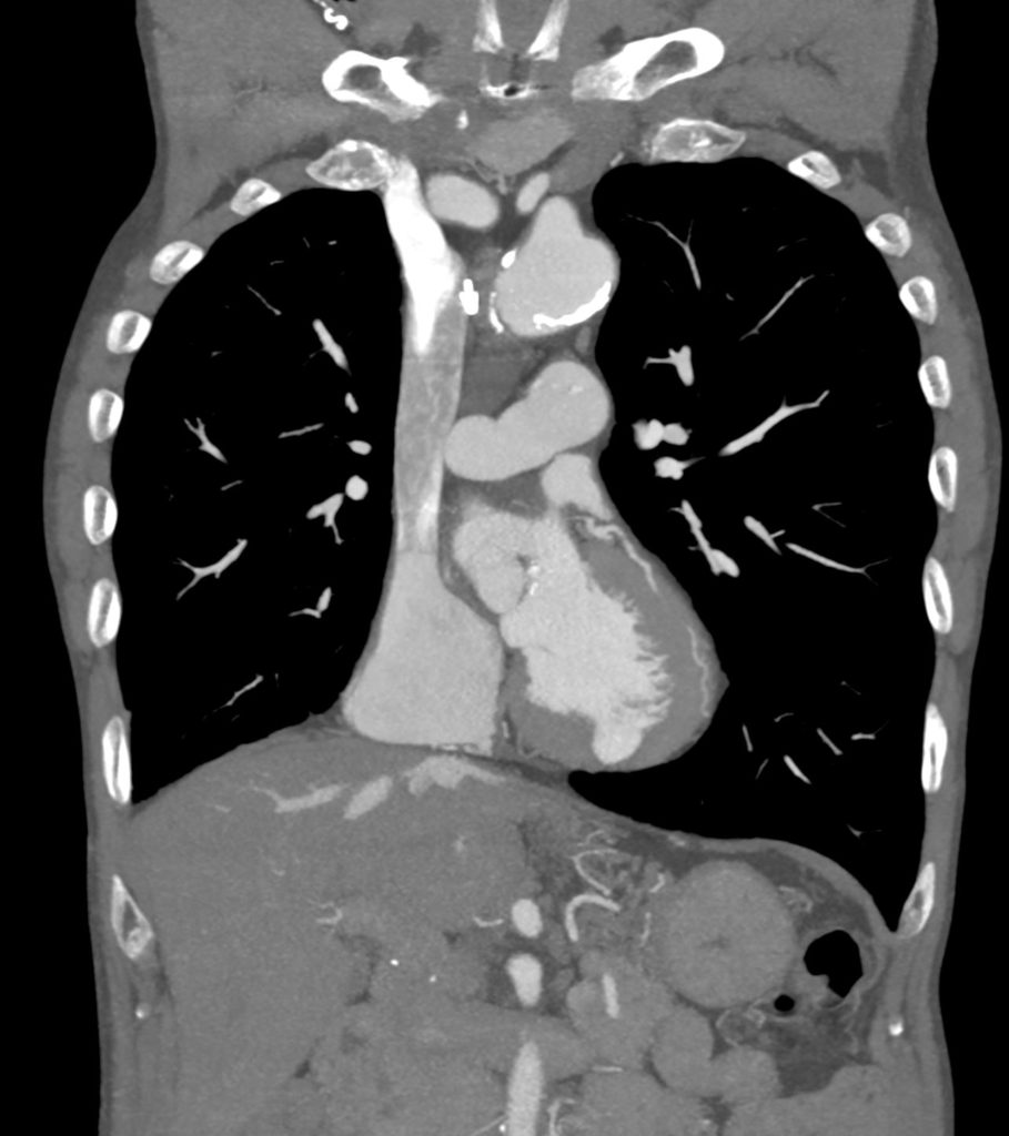 070H 80M LV Diverticulum vs Pseudoaneurysm | Heart