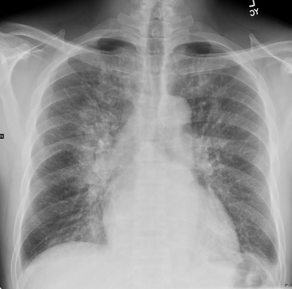 101H Cardiogenic Pulmonary Edema CXR and CT | Heart