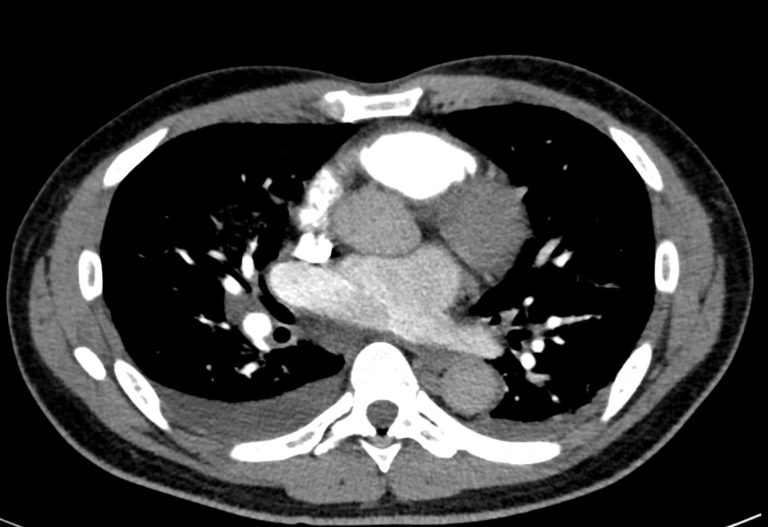 101H Cardiogenic Pulmonary Edema CXR and CT | Heart