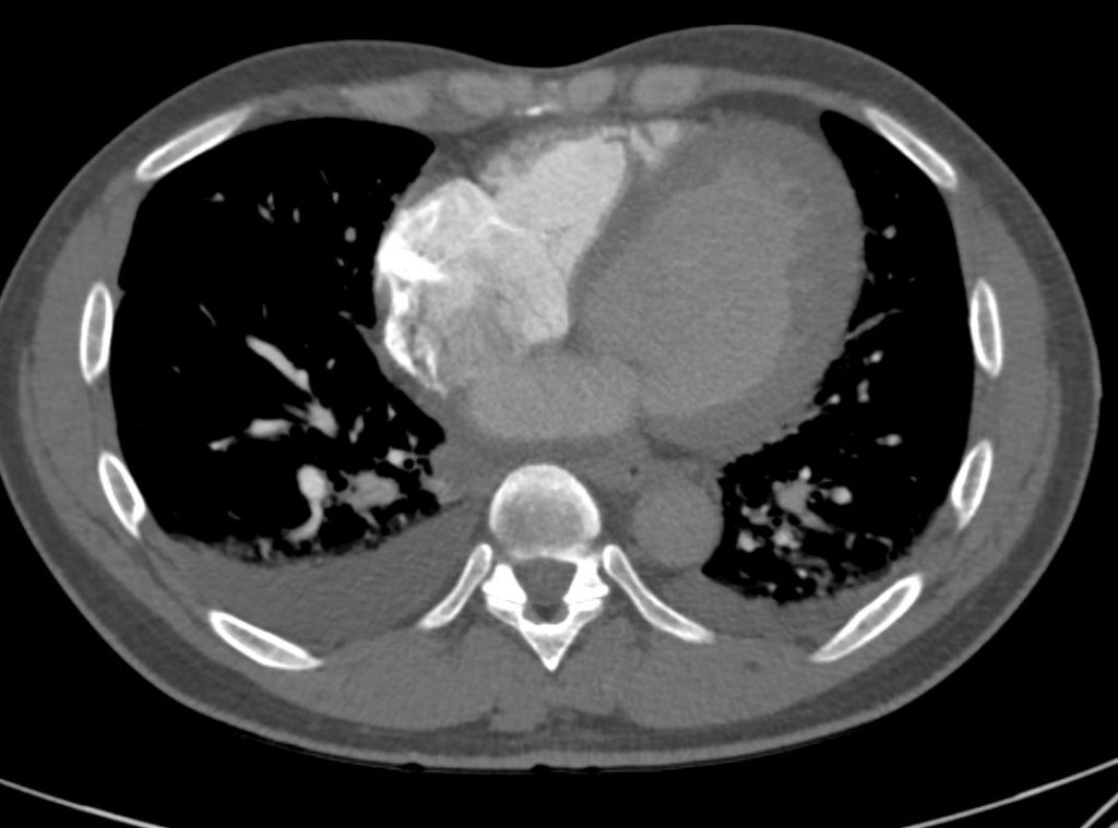 101H Cardiogenic Pulmonary Edema CXR and CT | Heart