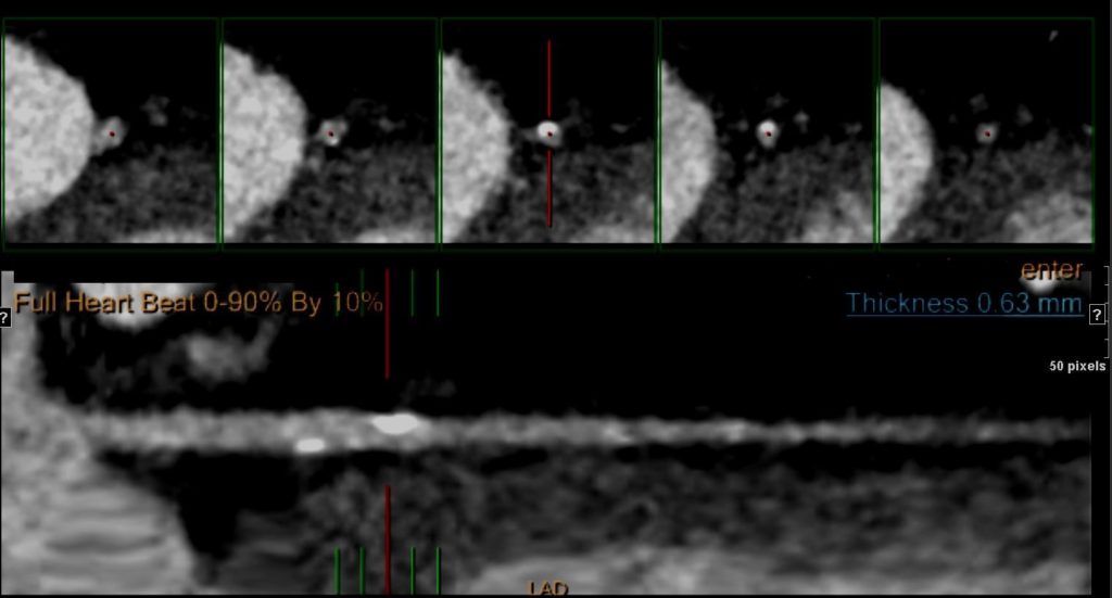 097H Chest pain LAD disease CTA Stress Cath positive Heart