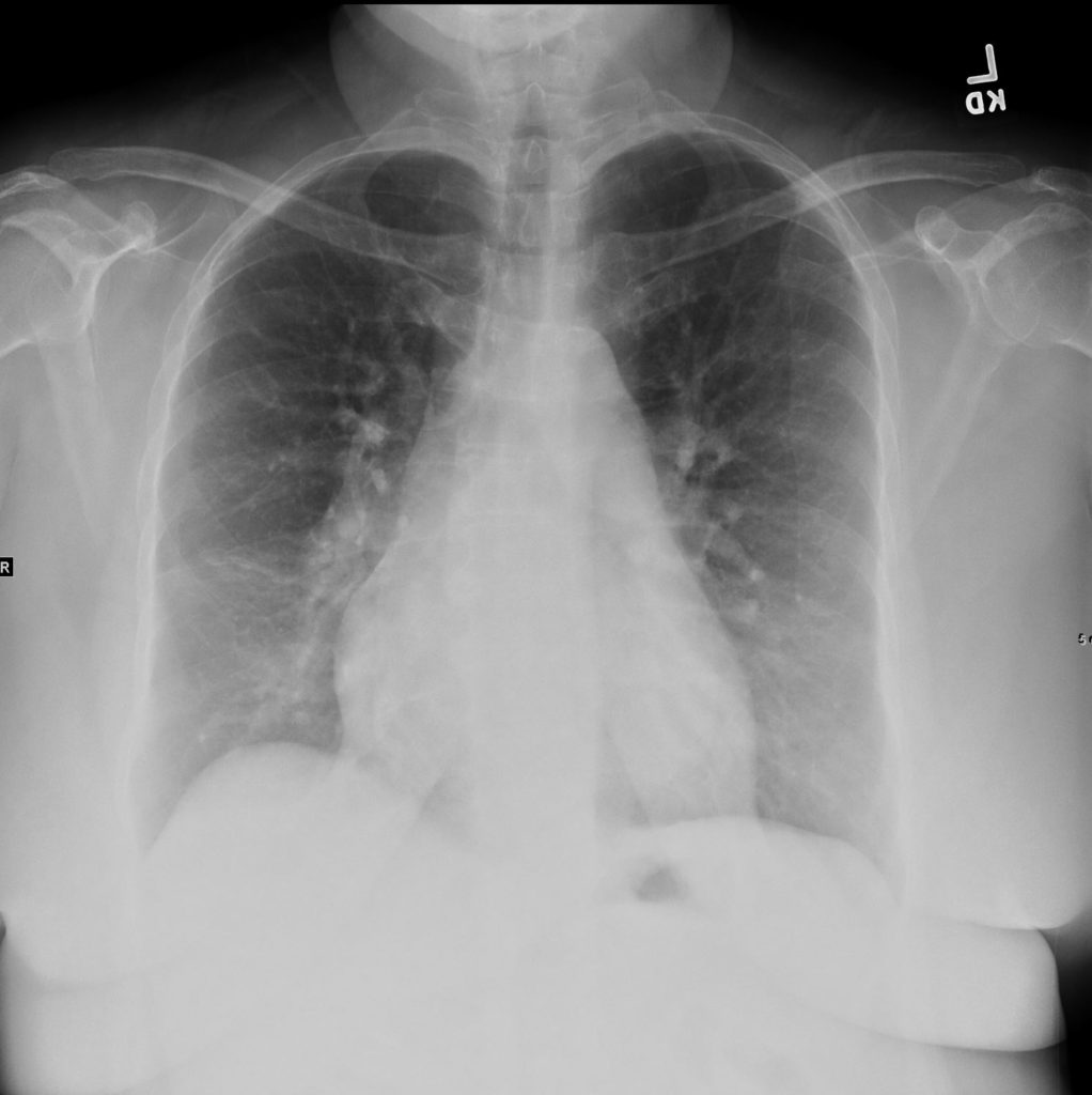 099H Sinus Venosus ASD PAPVR LSVC Pulmonary Hypertension | Heart