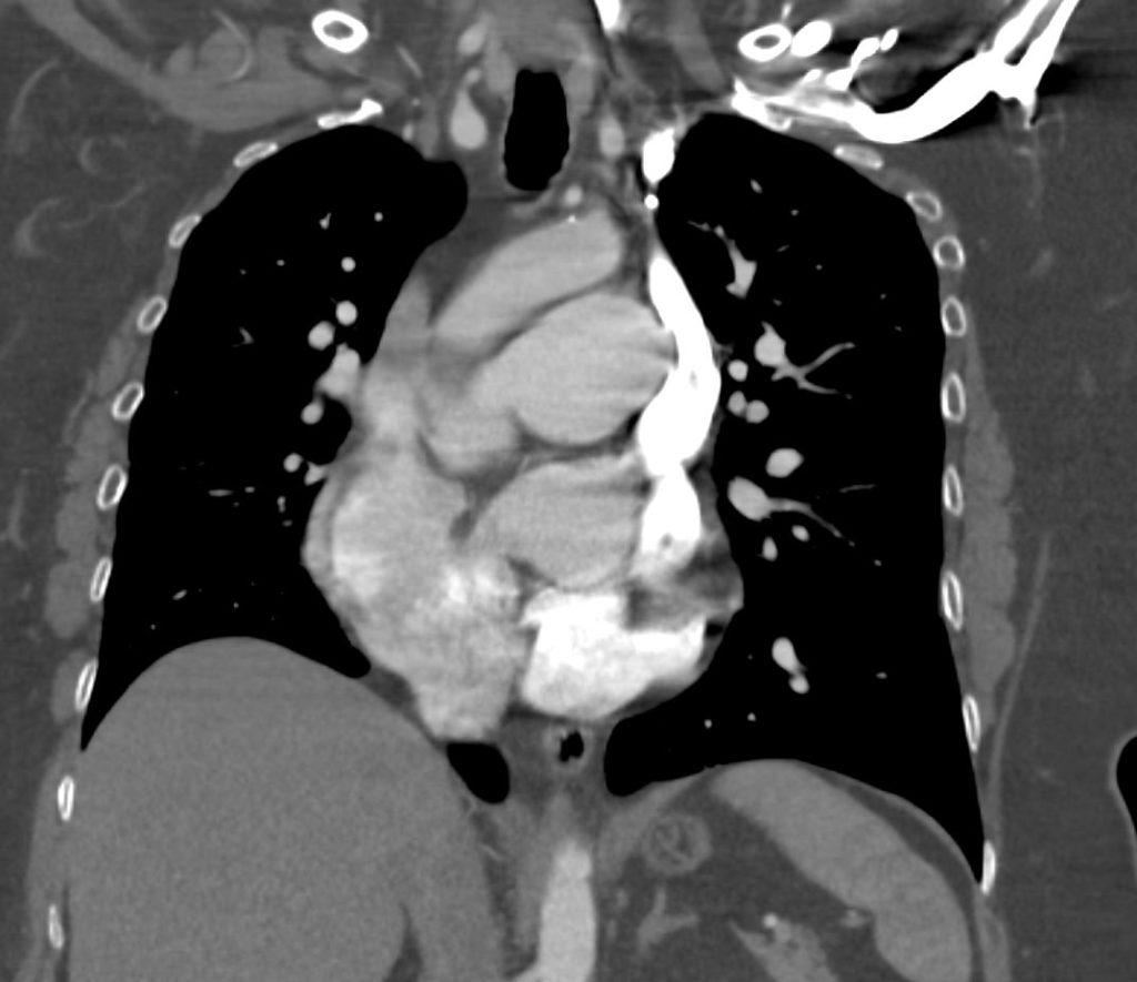 099H Sinus Venosus ASD PAPVR LSVC Pulmonary Hypertension | Heart