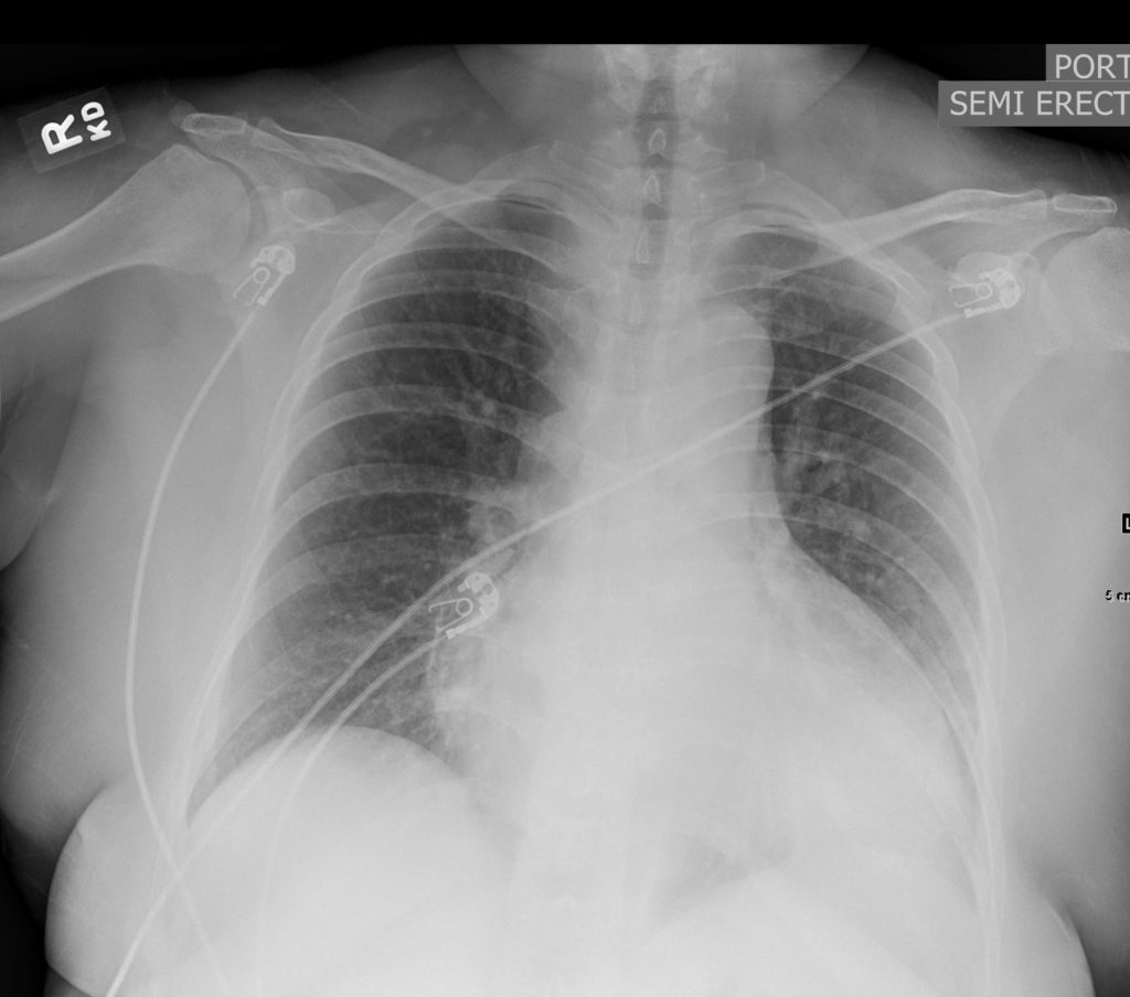 103H Type Aortic Dissection with RCA dissection | Heart