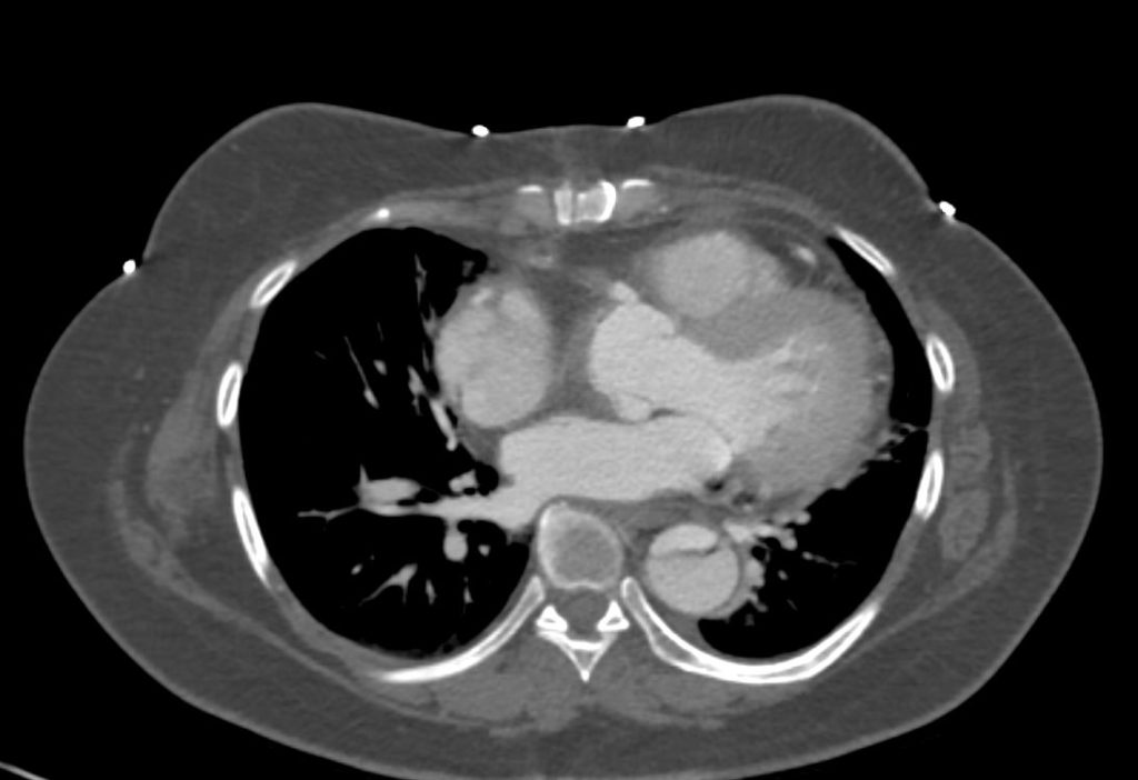 103H Type Aortic Dissection with RCA dissection | Heart