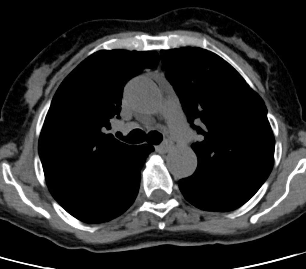 003 pericardial recess | Heart