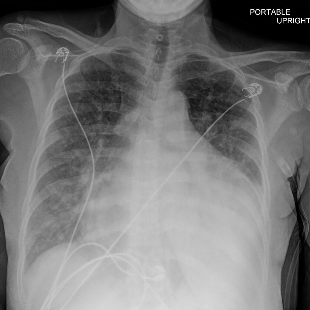 113H ASD Sinus Venosus PAH Pericardial Effusion | Heart