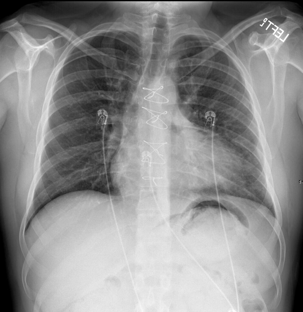 112H Tetralogy of Fallot Post Op | Heart