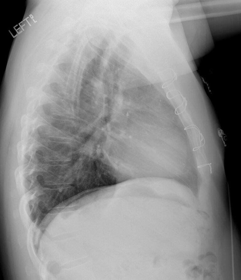 112H Tetralogy of Fallot Post Op | Heart