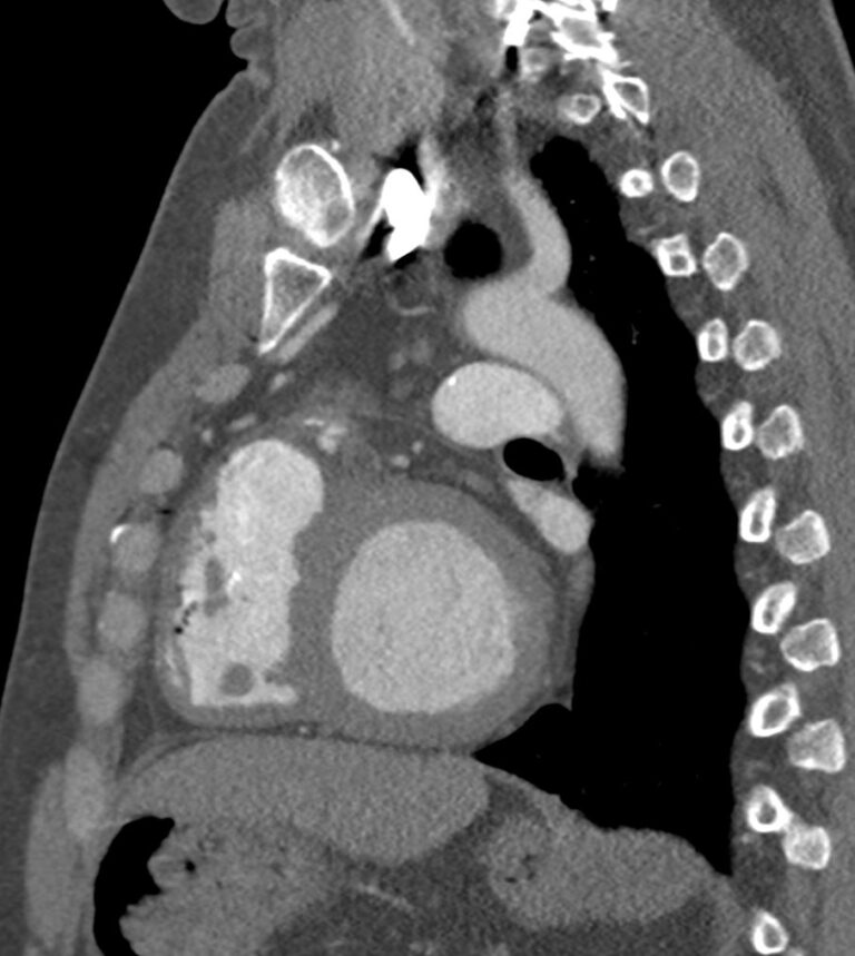 112H Tetralogy of Fallot Post Op | Heart