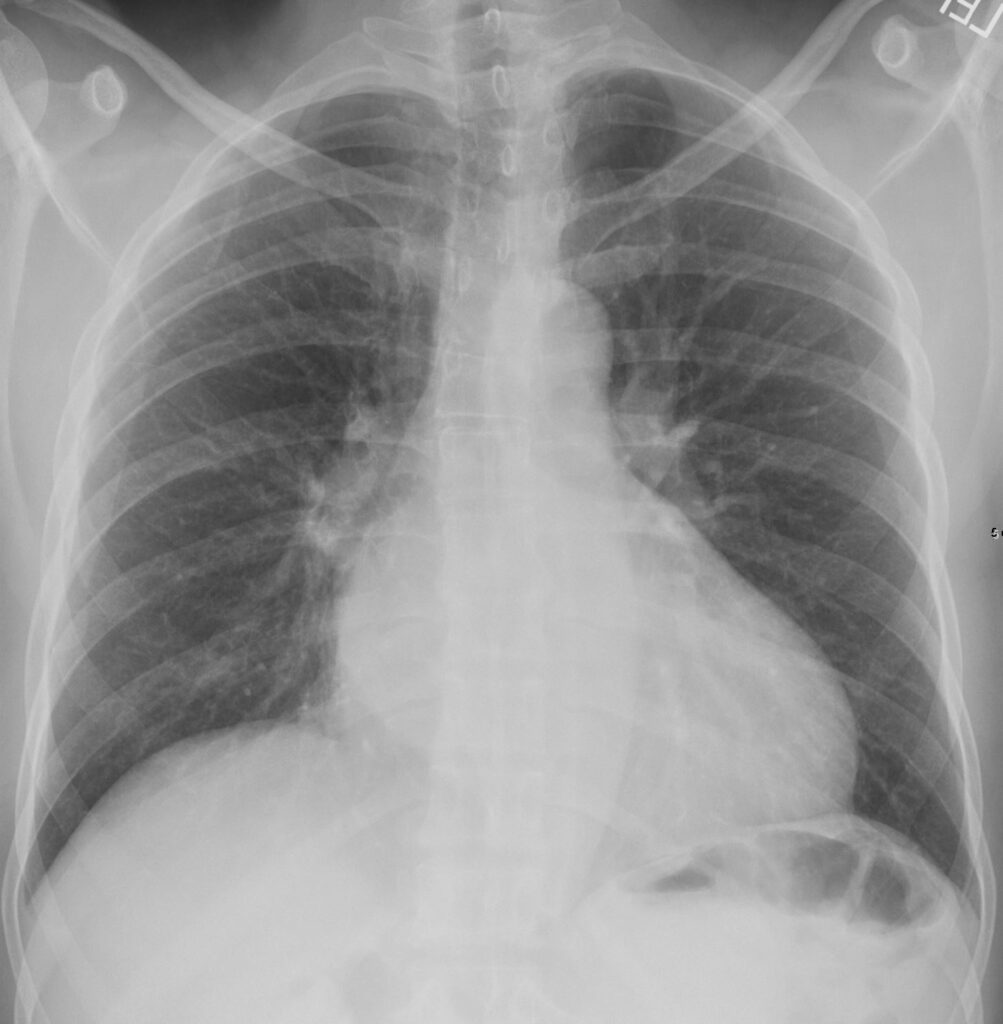 cxr-and-mitral-valve-disease-heart