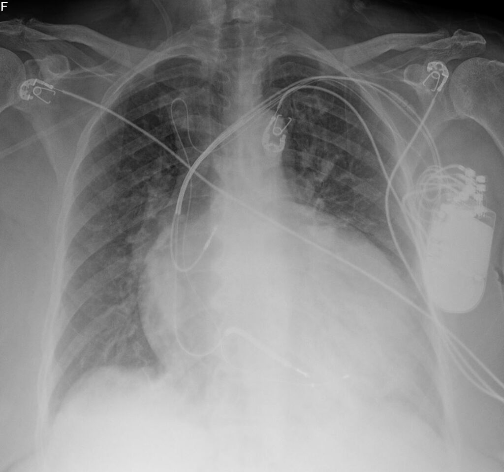 117H Congenital Rubella with mild PS and PDA | Heart